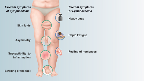 Lymphedema: Causes, Symptoms, and Everyday Tips for Better Understanding and Well-being